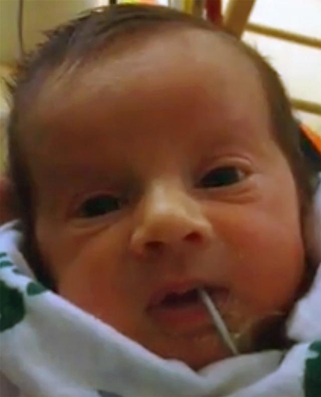 Baby with feeding tube, but no nose clip.